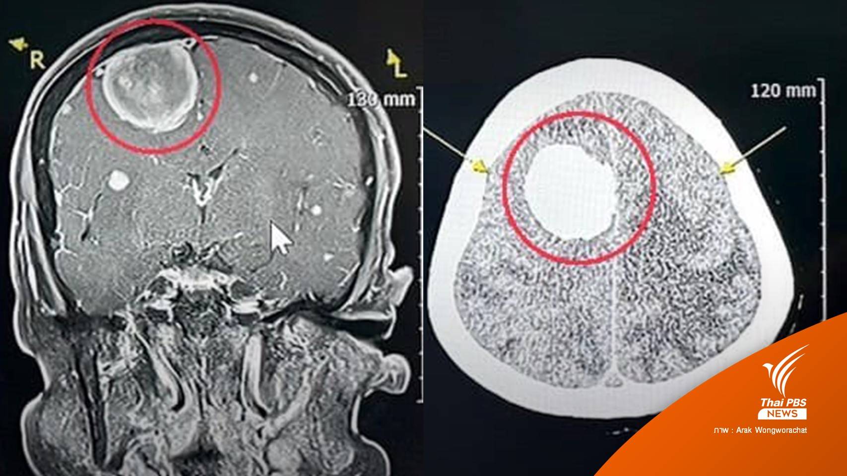 หมอยกเคสเตือนปวดหัวเรื้อรัง สุดท้ายตรวจพบ "เนื้องอกเยื่อหุ้มสมอง"