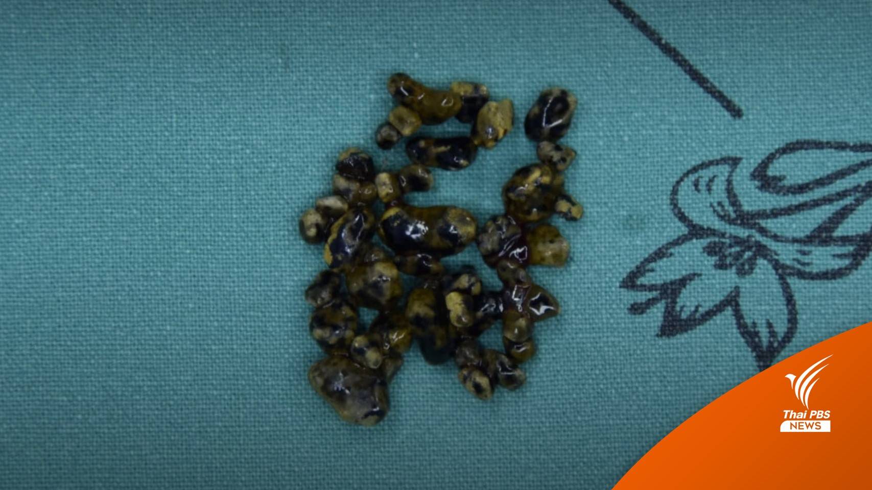 หญิง 35 ปี ปวดท้องรุนแรง พบนิ่วในถุงน้ำดี กว่า 40 ก้อน