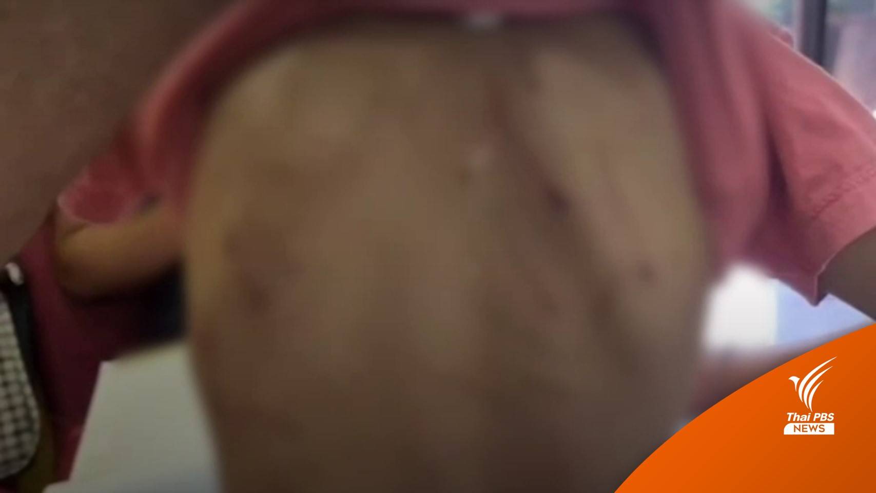 พบ ด.ช.วัย 6 ขวบถูกคนในครอบครัวทำร้าย นำตัวส่งฟื้นฟูร่างกาย-จิตใจ