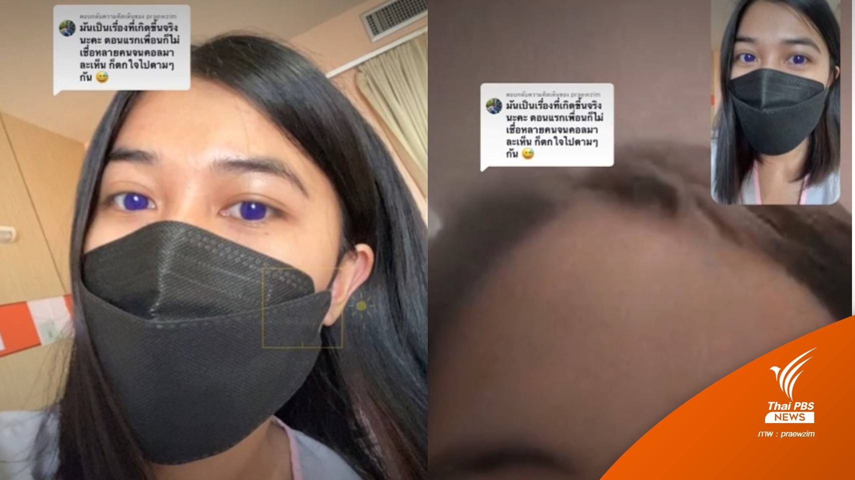 สาว "ตาสีม่วง" หลังกินยาฟาวิพิราเวียร์รักษาโควิด หมอระบุเป็นไปได้