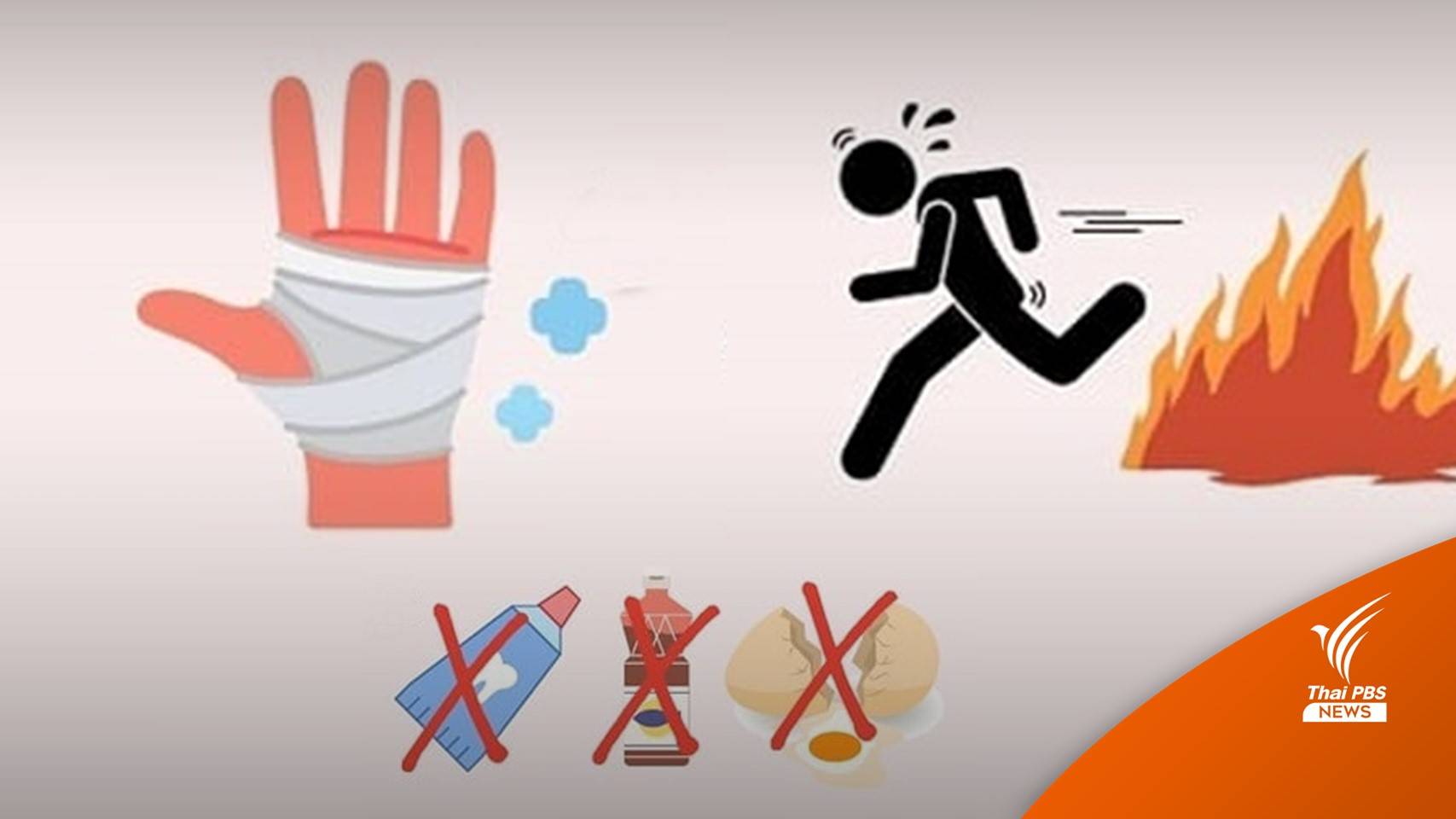 แนะวิธีดูแลแผลไฟไหม้ แพทย์ชี้ไม่ควรทายาสีฟัน-ไข่ขาว-น้ำปลา