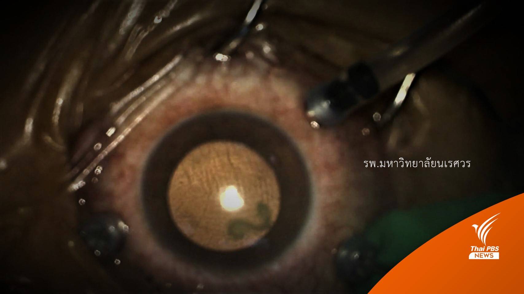 "กุ้งแช่น้ำปลา" ทำ "ตาบอด" พบพยาธิปอดหนูไชขึ้นตา