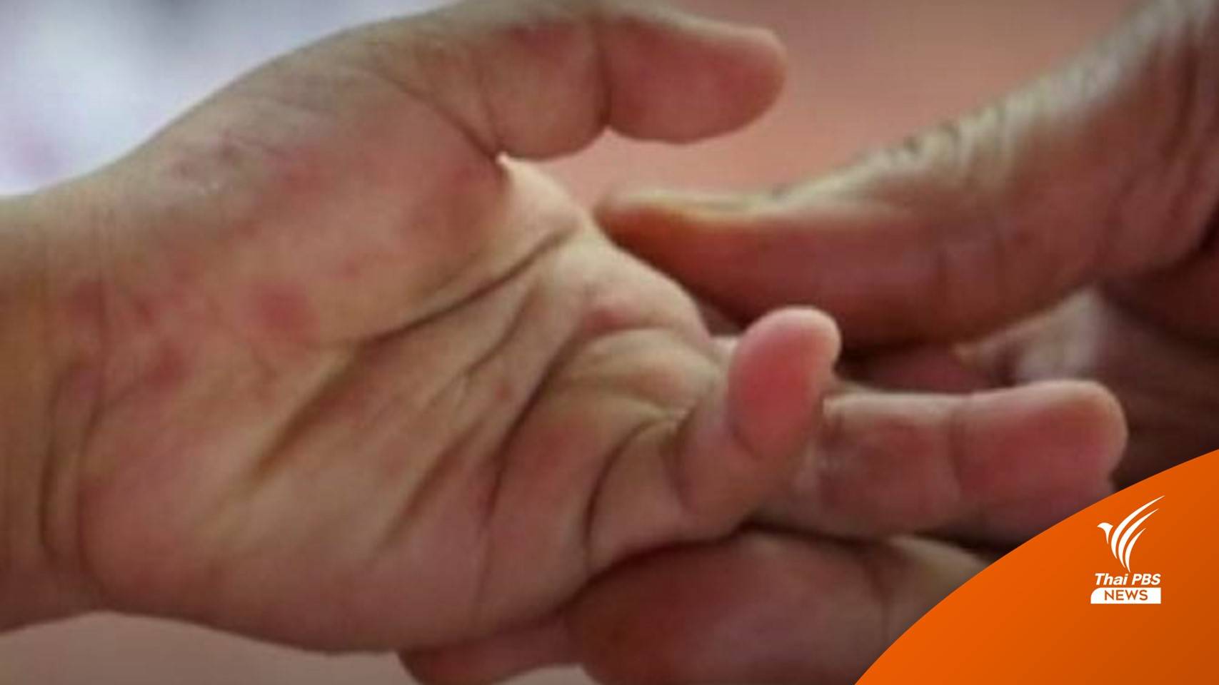 รู้ก่อนป้องกันได้ "โรคมือเท้าปาก" ปี 65 เด็กป่วยแล้วกว่า 200 คน