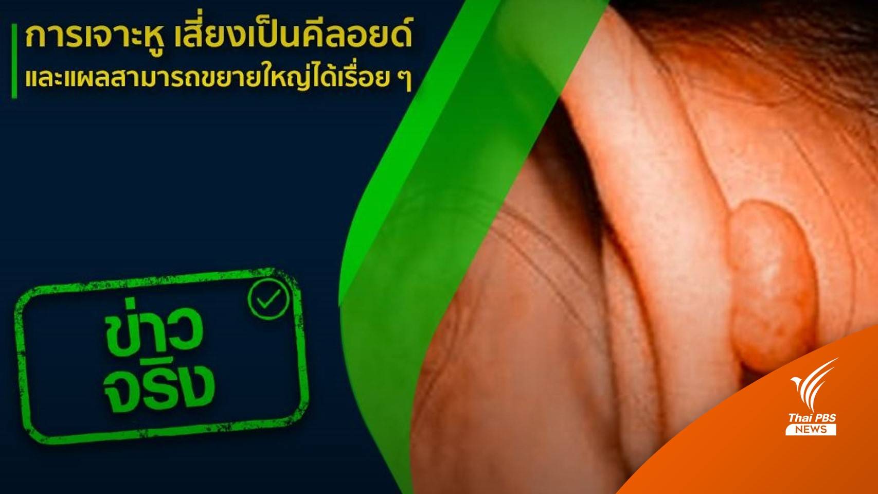 เตือน "เจาะหู" เสี่ยงเป็น "คีลอยด์" แนะเจาะด้วยเทคนิคปราศจากเชื้อ