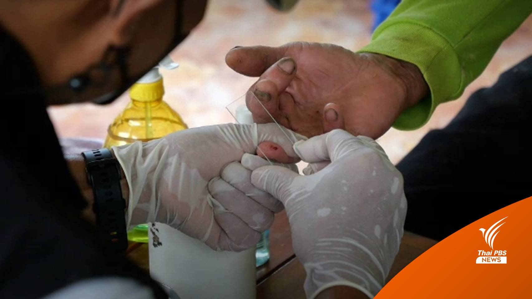 เก็บตัวอย่างเลือดชาวระนอง 60 คน กลุ่มเสี่ยงไข้ "มาลาเรียโนวไซ"