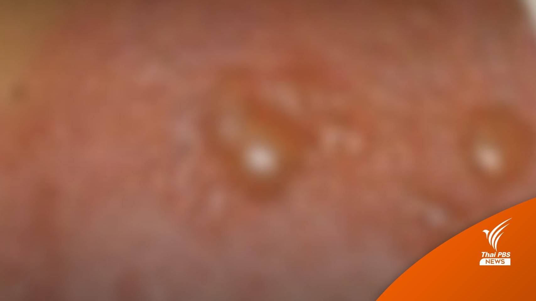 แพทย์ผิวหนัง ชี้พักผ่อนน้อย เสี่ยง "โรคงูสวัด"