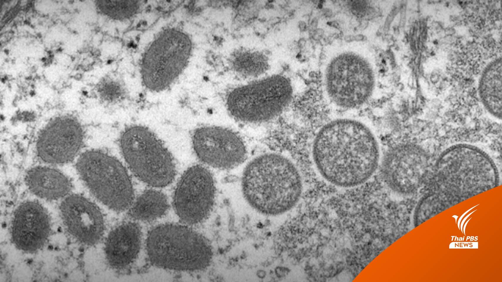 พบข้อมูล "ฝีดาษลิง 2022" เปลี่ยนแปลงเร็วกว่าไวรัสปกติ 10 เท่า