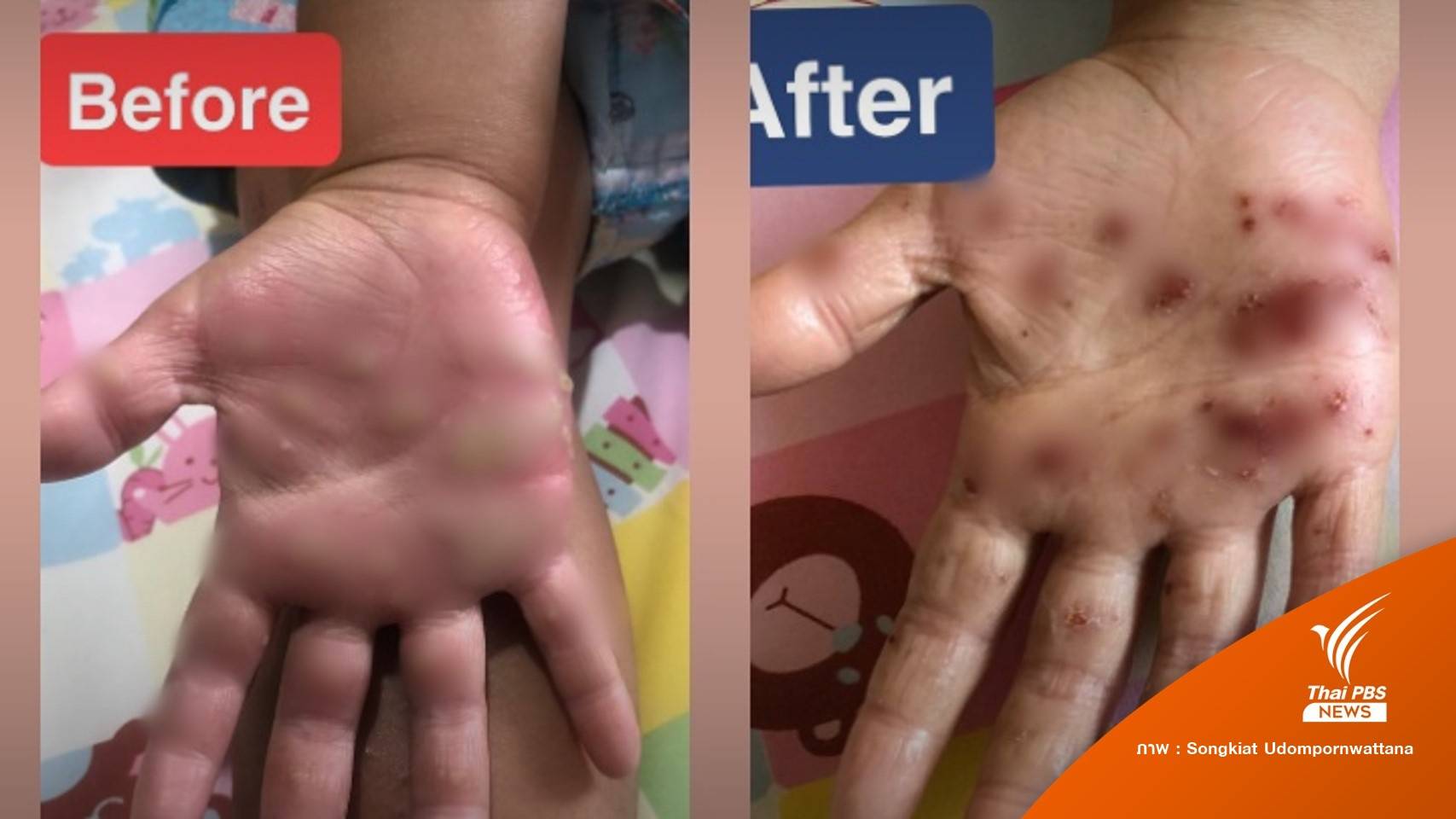 เตือน! เด็กเล่นดินทรายเสี่ยงติดเชื้อตุ่มหนองขึ้นมือ