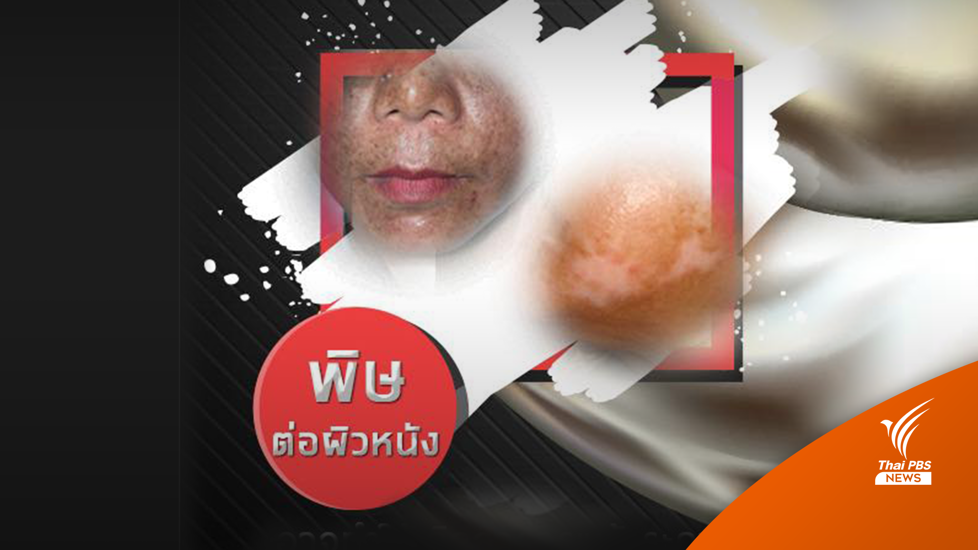 อย่าหาทำ! เอาสารปรอททาผิว หมอยันอันตรายต่อระบบประสาท-ผิว