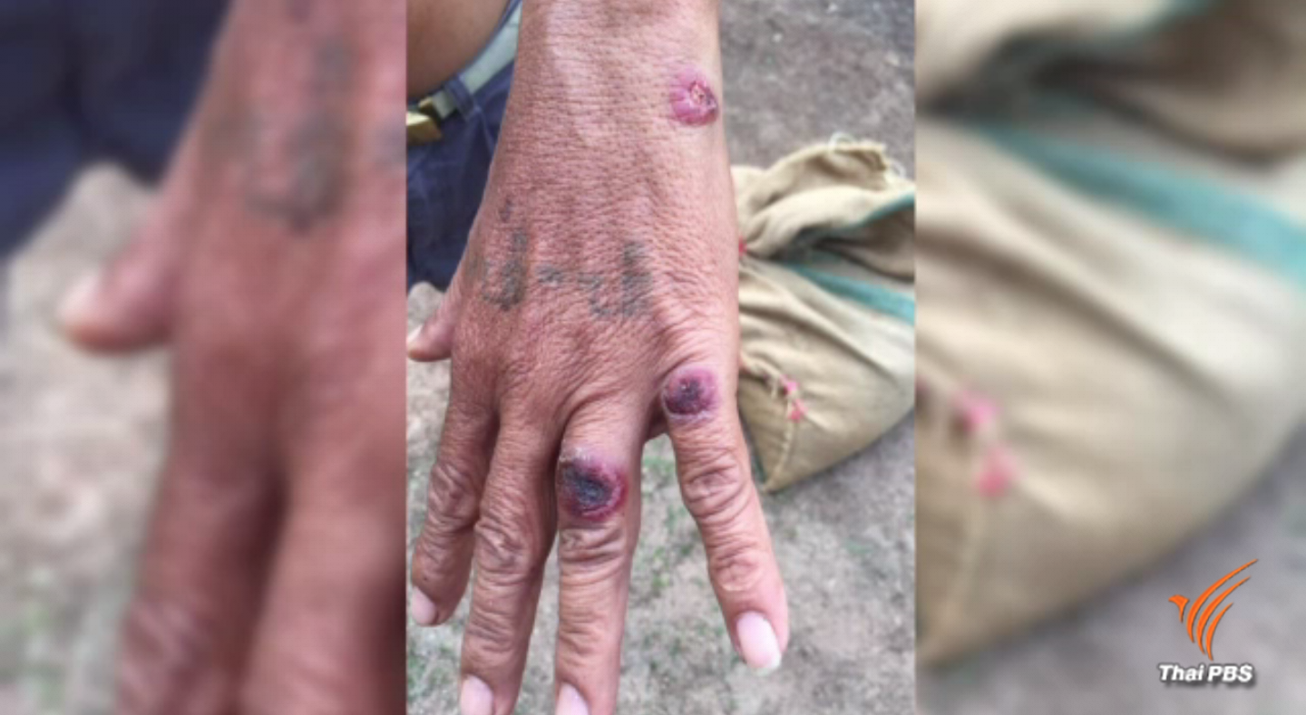 ชาวบ้านป่วยเป็นโรคแอนแทรกซ์ หลังรับประทานเนื้อแพะจากประเทศเพื่อนบ้าน