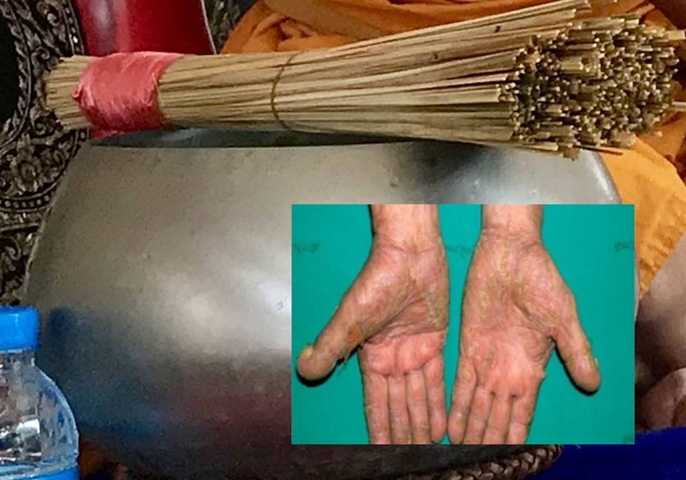 เตือน "ใช้น้ำมนต์" รักษาโรคผิวหนัง เสี่ยงติดเชื้อเพิ่มถึงขั้นตาย