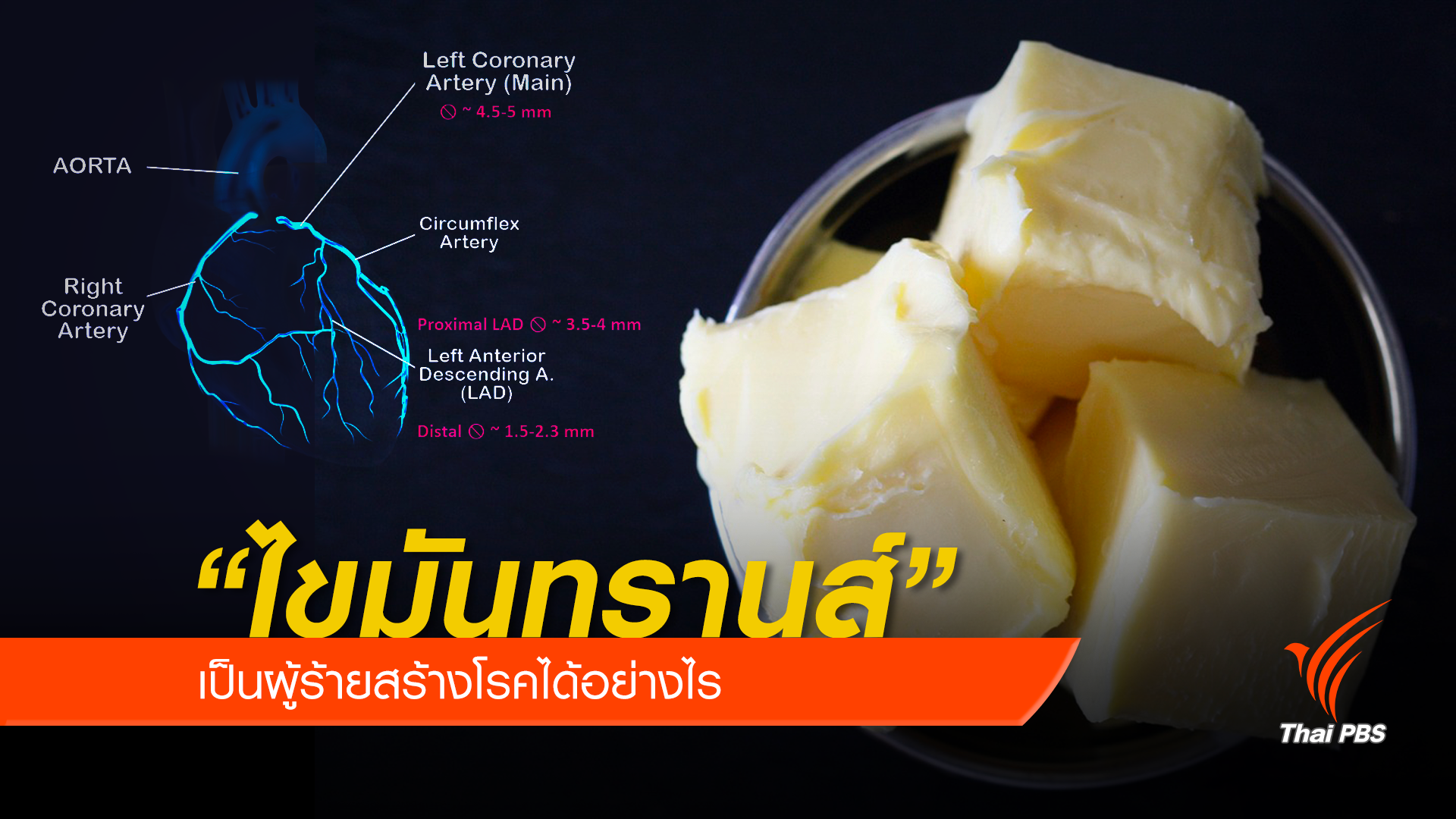 “ไขมันทรานส์” เป็นผู้ร้ายสร้างโรคได้อย่างไร