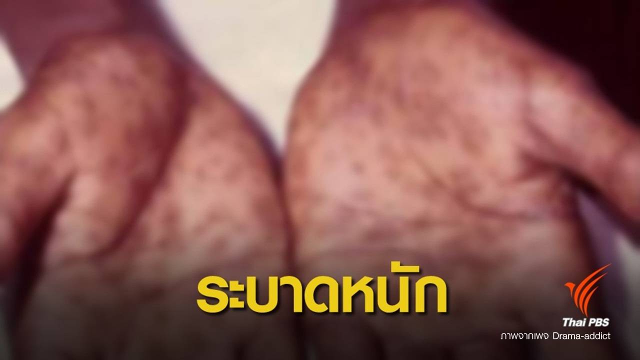 โลกโซเชียลแห่ให้ข้อมูล "ซิฟิลิส" ระบาด ไม่รีบรักษาอาจถึงตาย