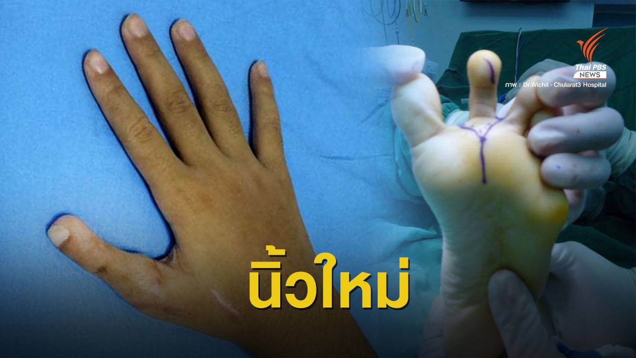 เปิดใจทีมแพทย์ ผู้ใช้ "นิ้วเท้าซ่อมมือ" ให้เด็กวัย 7 ขวบ
