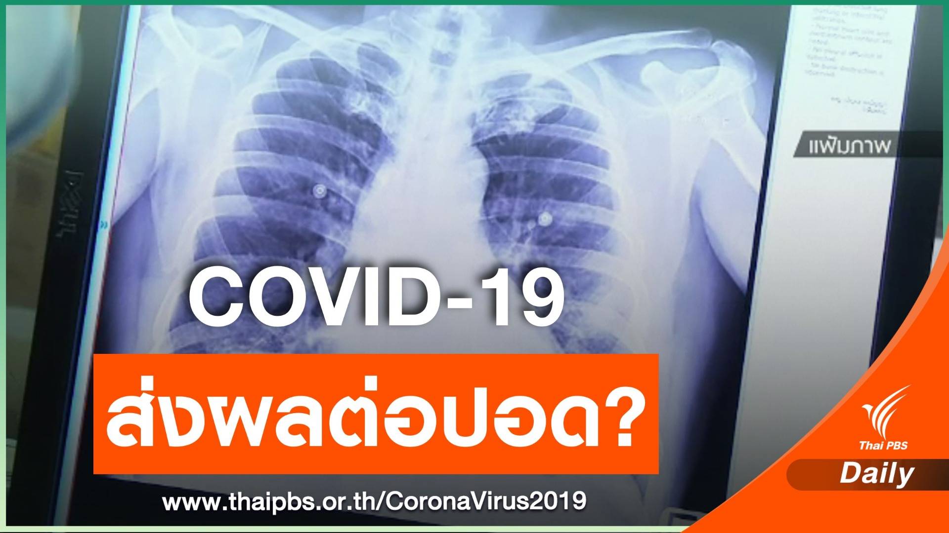 หมอแจงผู้ป่วย COVID-19 หายแล้ว ส่วนใหญ่ปอดยังทำงานได้ปกติ