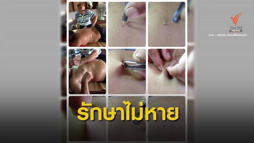เตือนมิจฉาชีพอ้างตัวเป็น "หมอดึงมะเร็ง"