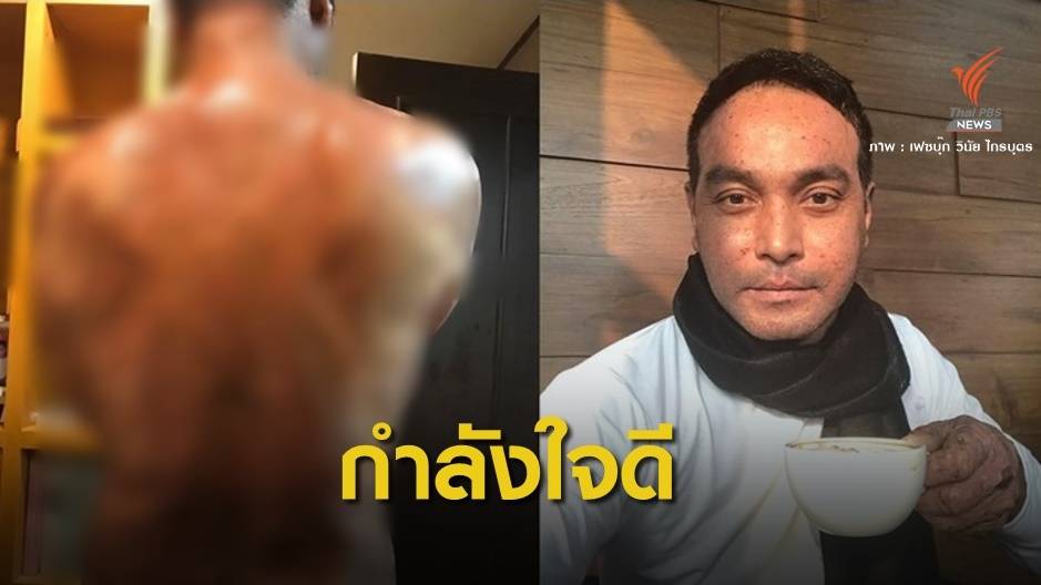 ขอสู้ ! เมฆ-วินัย โพสต์ "เจ็บ" แต่สู้ต่อโรคตุ่มน้ำพอง