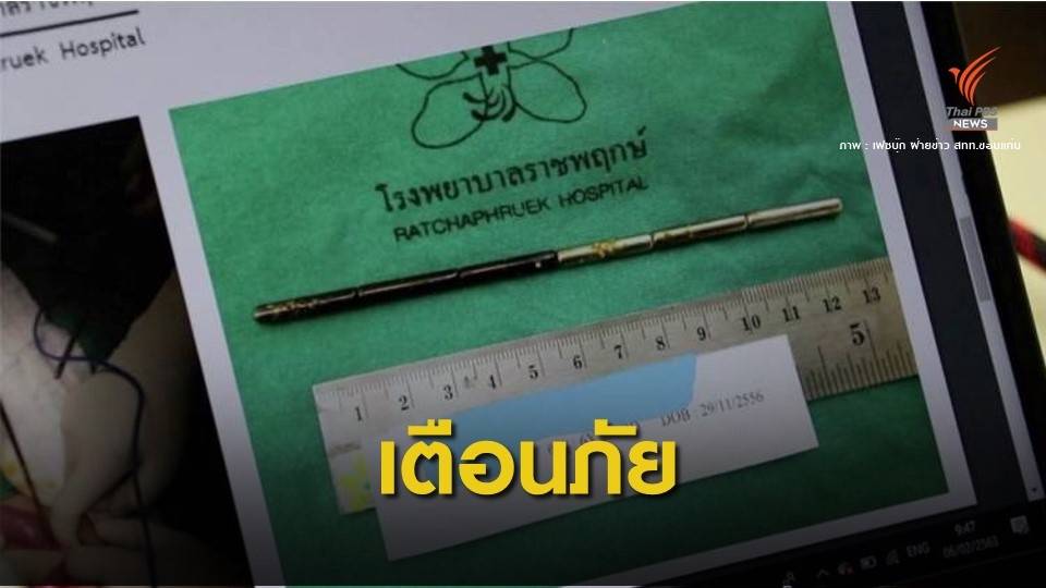 เด็ก 6 ขวบกลืนตัวต่อเหล็กฝังช่องท้องยาว 15 ซม.