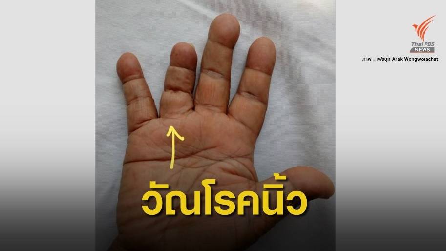 หมอเตือน "วัณโรคกระดูกลงนิ้วมือ" เจอเคสแรกในรอบ 15 ปี
