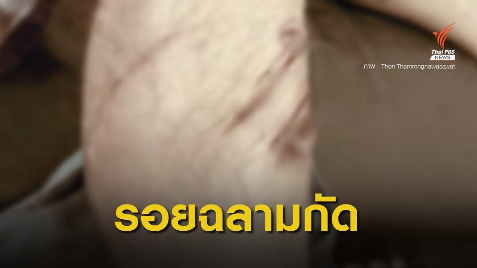 "ธรณ์" คาดฉลามหัวบาตร กัดนักท่องเที่ยวที่พังงา