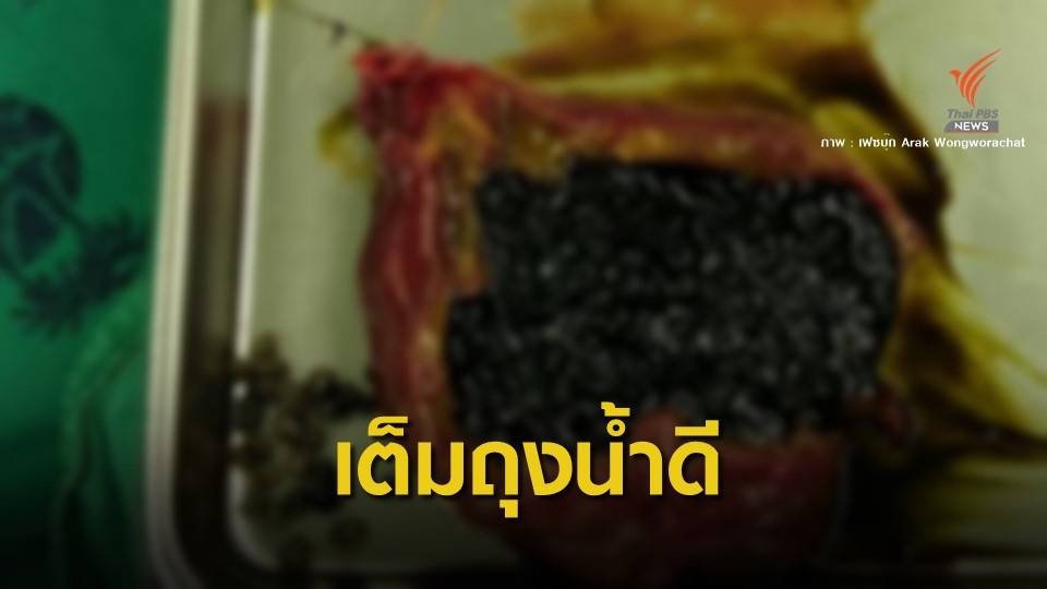 ตะลึง! นิ่ว 800 ก้อนคล้ายไข่มุกในถุงน้ำดี