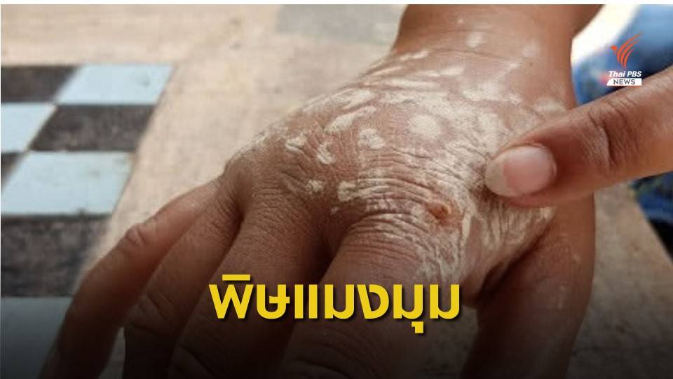 เตือน "แมงมุมพิษกัด" ห้ามประคบร้อนเสี่ยงพิษกระจาย
