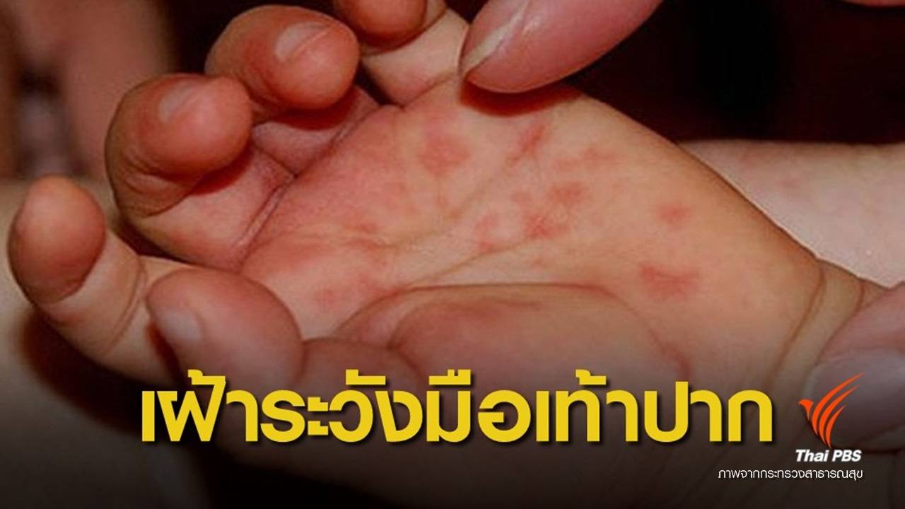 สธ.เร่งสอบสวนโรคหลังพบเด็ก ม.1 ป่วยไข้-ออกผื่น