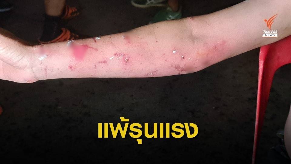 แจ้งความ สน.บางโพ ปมแพ้น้ำผสมสารเคมีฉีดผู้ชุมนุม