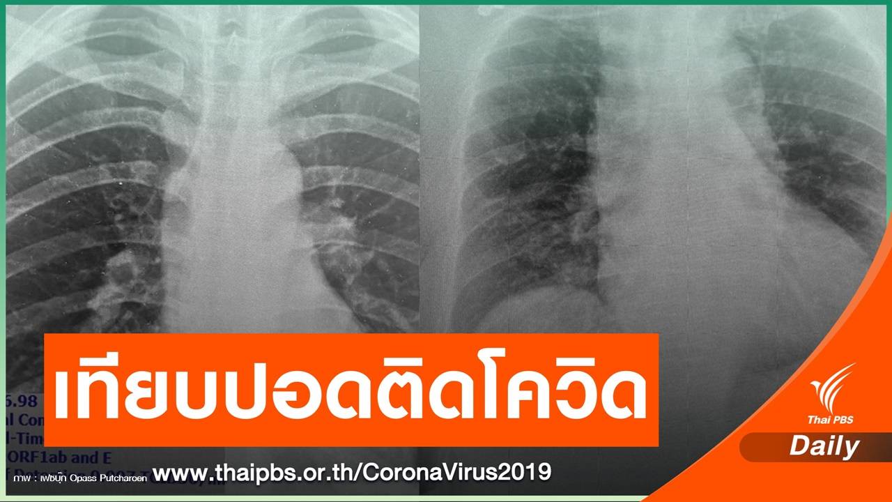 หมอโชว์ฟิล์มเอกซเรย์ปอดผู้ป่วย COVID-19 รอบใหม่ไม่เหมือนเดิม