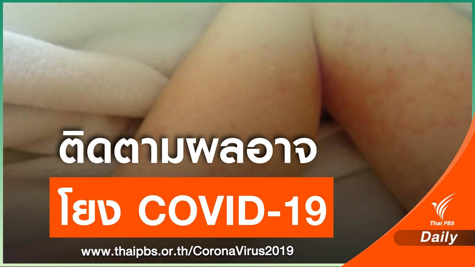 หมอยงชี้อาการป่วยในเด็กอังกฤษ-สหรัฐฯ คล้าย "โรคคาวาซากิ"
