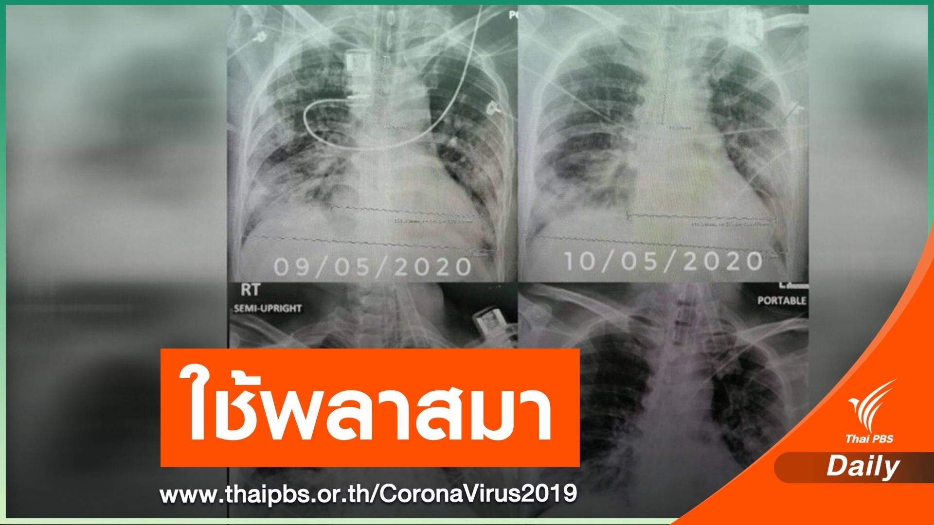 สำเร็จ ! ใช้พลาสมารักษาจนหายป่วย COVID-19