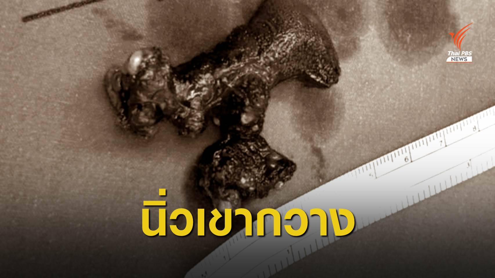 เปิดเคสชายวัย 78 ปี ปวดท้องนาน 6 เดือนพบ "นิ่วเขากวาง" ในไต