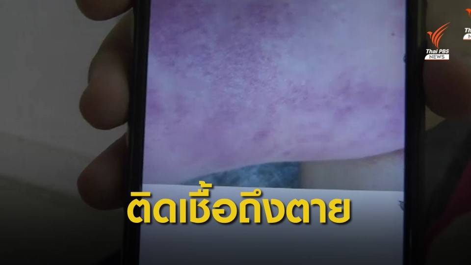 หมอเตือน "ตะขาบกัด" เสี่ยงติดเชื้อเข้ากระแสเลือดถึงตาย