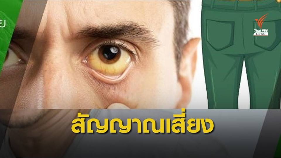 หมอเตือน "ตาเหลือง-ตัวเหลือง" สัญญาณเสี่ยงมะเร็งตับ