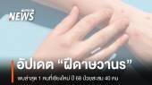 "ฝีดาษวานร" ปี 68 ป่วยสะสม 40 คน รายล่าสุดพบที่เชียงใหม่  