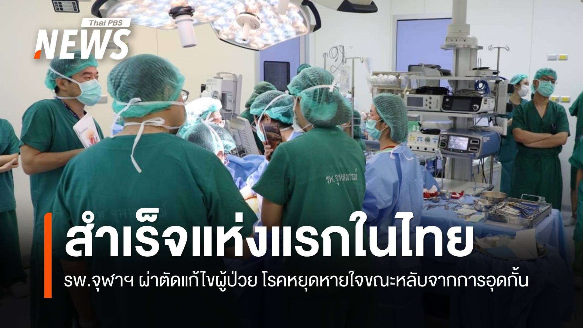 รพ.จุฬาฯ ผ่าตัดแก้ไขผู้ป่วย "โรคหยุดหายใจขณะหลับจากการอุดกั้น" สำเร็จแห่งแรกในไทย  
