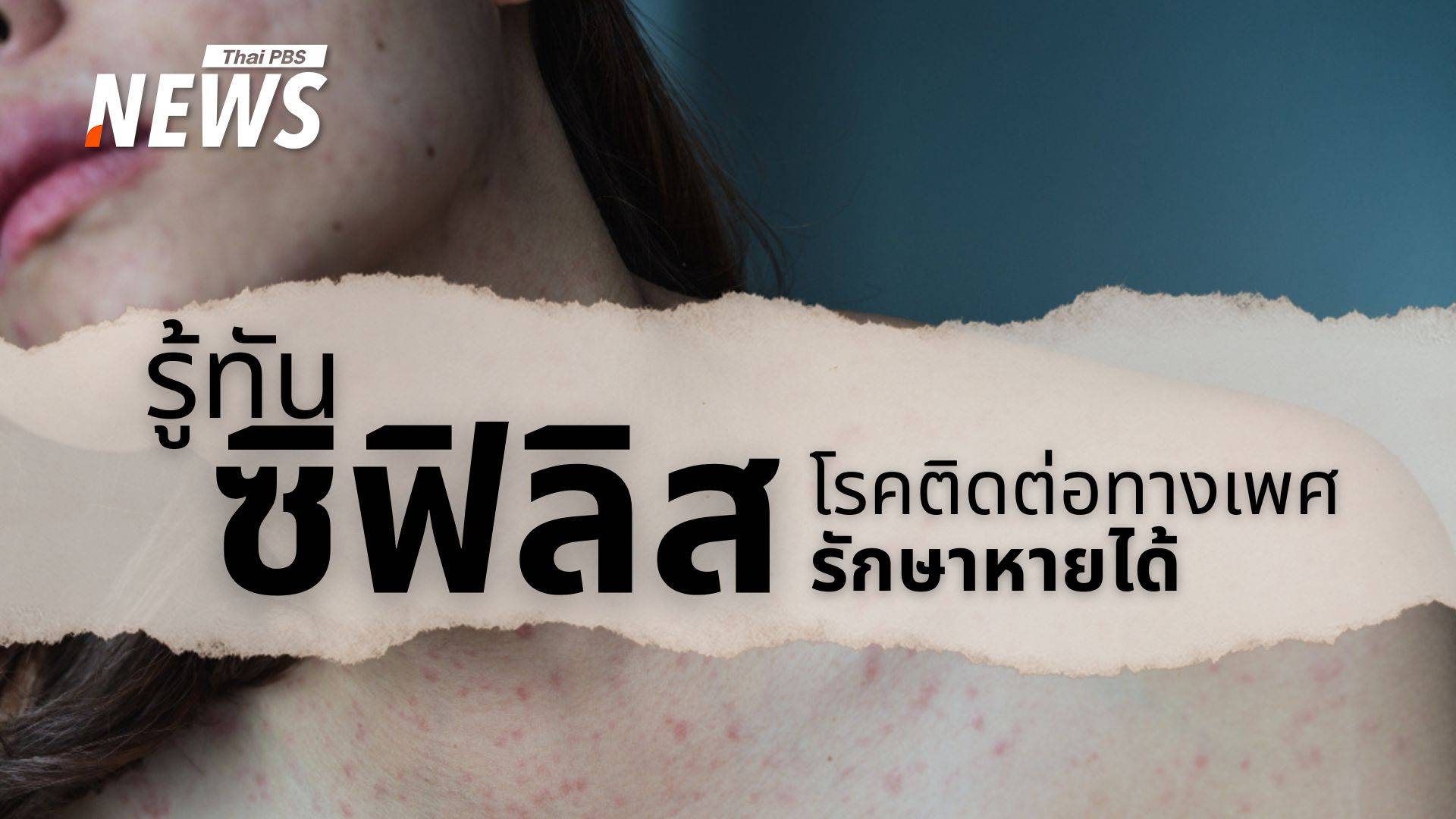 "ซิฟิลิส" โรคเก่าระบาดใหม่! ภัยเงียบโรคติดต่อทางเพศสัมพันธ์