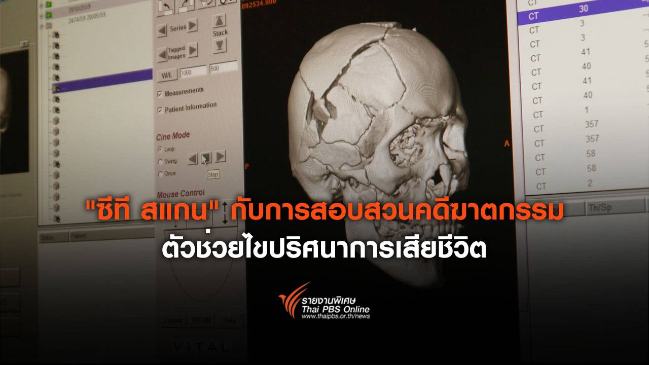 "ซีที สแกน" กับการสอบสวนคดีฆาตกรรม ตัวช่วยไขปริศนาการเสียชีวิต