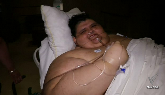 ผ่าตัด "ชายอ้วน" มากที่สุดในโลกในเม็กซิโก
