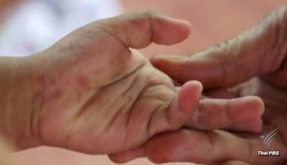 เตือน "มือ เท้า ปาก" ระบาดช่วงเปิดเทอม 4 เดือนป่วย 11,326 คน