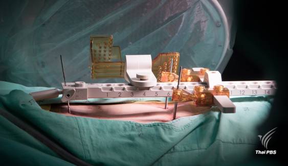 “เรเนซอง “หุ่นยนต์ช่วยผ่าตัดกระดูกสันหลัง ตัวแรกของไทย