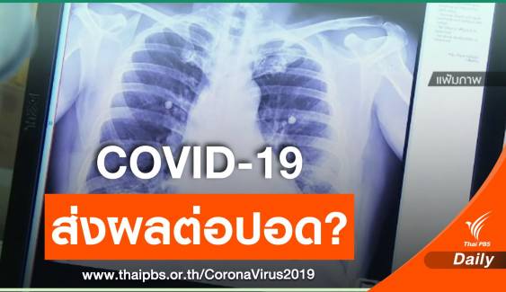 หมอแจงผู้ป่วย COVID-19 หายแล้ว ส่วนใหญ่ปอดยังทำงานได้ปกติ