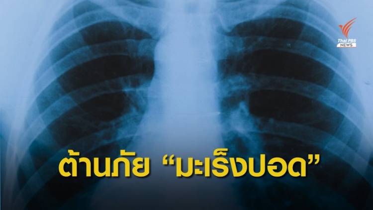 คนไทยป่วยมะเร็งปอดเพิ่มวันละ 42 คน แนะตรวจเร็วลดเสี่ยงเสียชีวิต