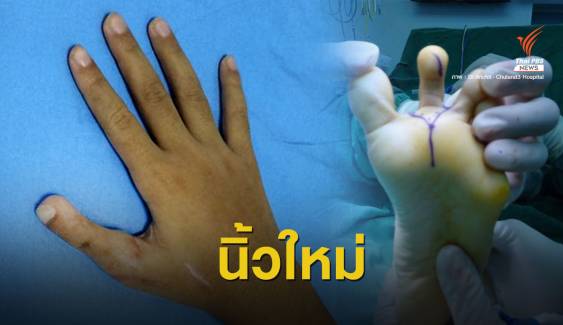 เปิดใจทีมแพทย์ ผู้ใช้ "นิ้วเท้าซ่อมมือ" ให้เด็กวัย 7 ขวบ 