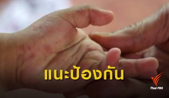 เตือนระวังโรค "มือ เท้า ปาก" ปีนี้พบป่วยแล้ว 10,775 คน