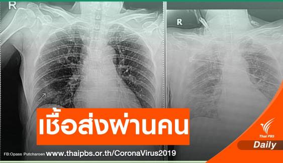 หมอเตือนตัวอย่างจริงไม่กักตัวส่งเชื้อ COVID-19 ติดแม่