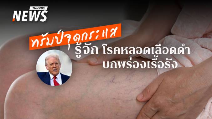 รู้จัก CVI &quot;โรคหลอดเลือดดำบกพร่องเรื้อรัง&quot; ที่หลายคนมองข้าม