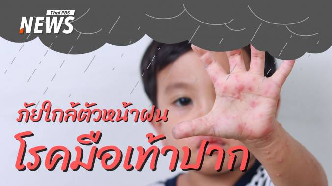 รู้ทัน &quot;มือเท้าปาก&quot; ภัยใกล้ตัวลูกในหน้าฝน ที่พ่อแม่ต้องรู้