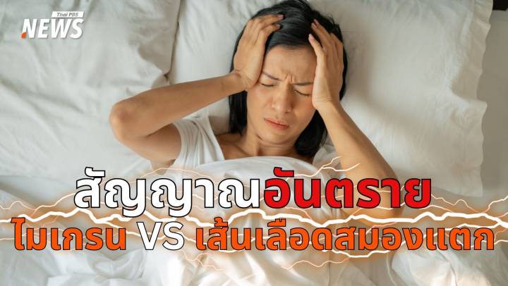 ไมเกรน VS เส้นเลือดสมองแตก ปวดหัวแบบไหน อันตรายถึงชีวิต ? 