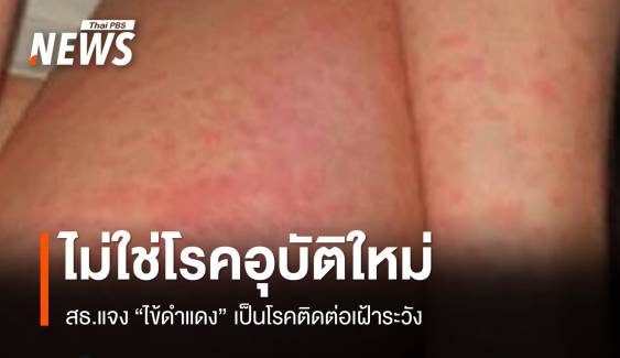 สธ.แจง "ไข้ดำแดง" ไม่ใช่โรคอุบัติใหม่ พบ 2 เดือนป่วย 455 คน